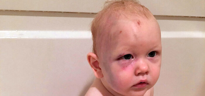 رشد کیفی زندگی بیماران هموفیلی در گرو کاهش هزینههای درمان