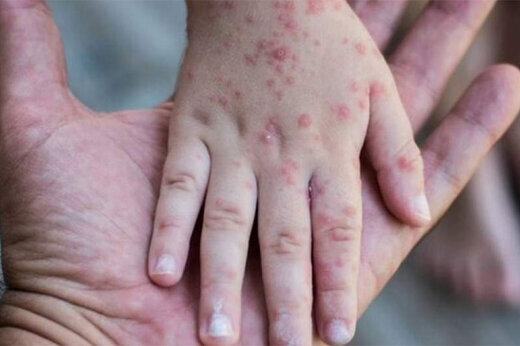 بازگشت سرخک به ایران؛ ضرورت توجه بیشتر به بیماریهای واگیردار در پساکرونا 2