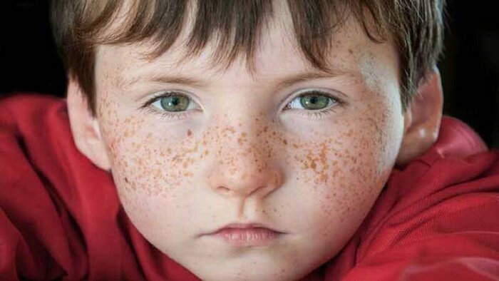 تفاوت بین لکه پوستی مادرزادی، خال و ککومک چیست؟