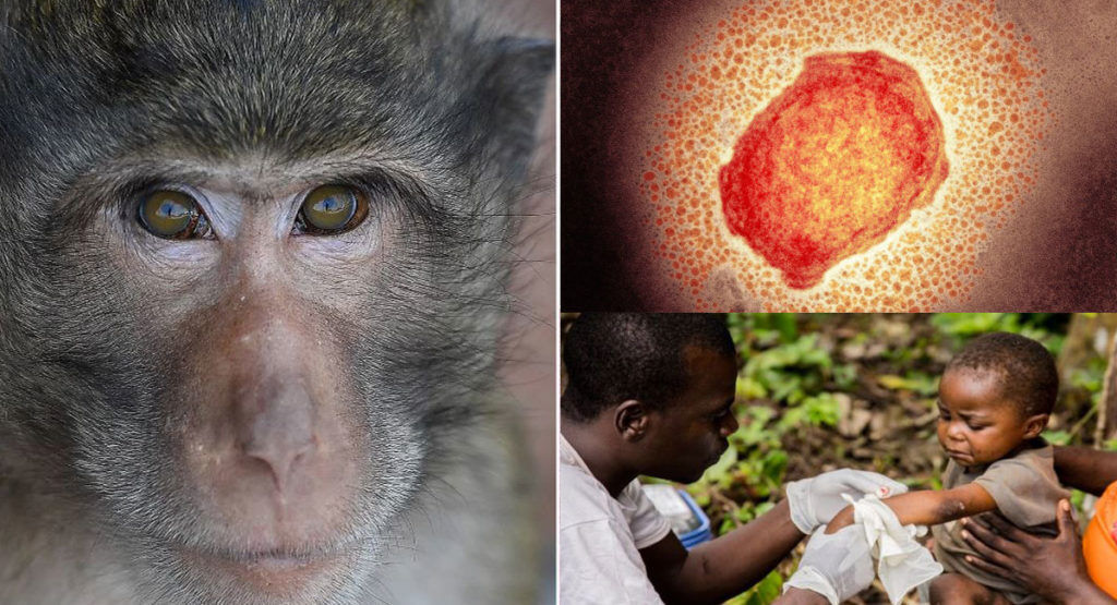 تفاوت‌ها و شباهت‌های علائم آبله میمون و بیماری زونا