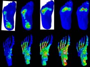 بررسی انگشتان پای دیابتی‌ها برای طراحی کفش و کفی‌های مخصوص 