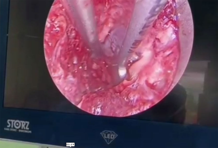 نخستین عمل آندوسکوپی ستون فقرات در بیمارستان میبد انجام شد