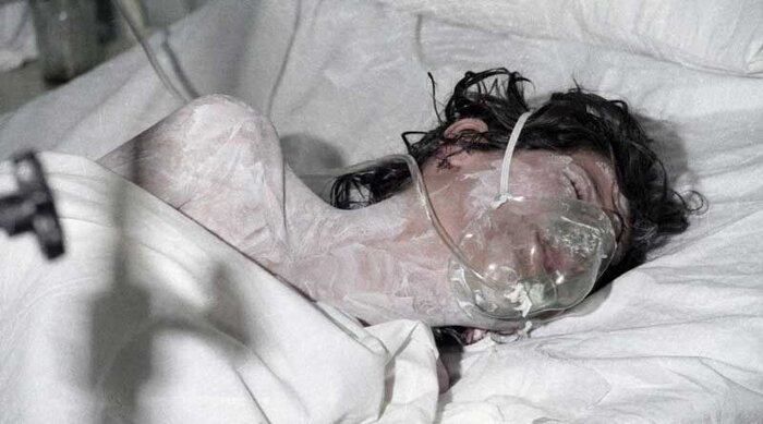 Int’l silence on 1978 Sardasht chemical attack becomes 35 years old