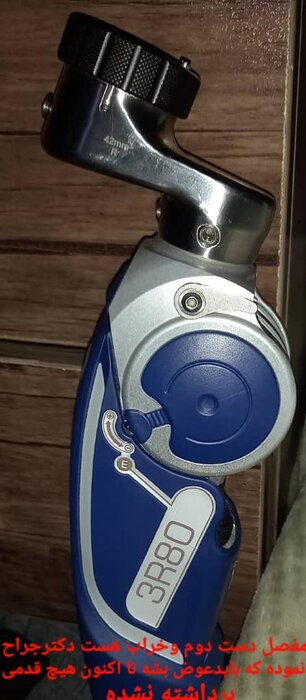 ماجرای کاشت پای مصنوعی یک جانباز؛ خطای پزشکی یا ادعای بیمار؟