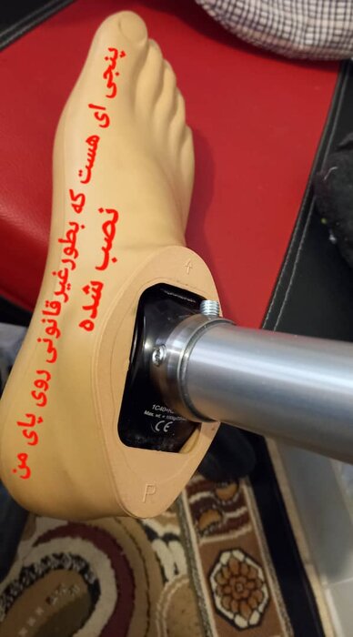 ماجرای کاشت پای مصنوعی یک جانباز؛ خطای پزشکی یا ادعای بیمار؟