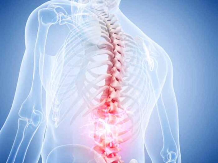 چگونه میتوان دیسک کمر را درمان کرد؟ 4