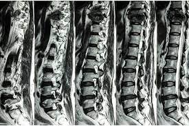 چگونه میتوان دیسک کمر را درمان کرد؟ 5