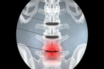 چگونه میتوان دیسک کمر را درمان کرد؟ 6