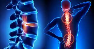 چگونه میتوان دیسک کمر را درمان کرد؟ 7
