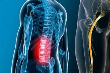 چگونه میتوان دیسک کمر را درمان کرد؟ 8