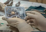۵۸ جراحی کاشت حلزون در گیلان با موفقیت انجام شد