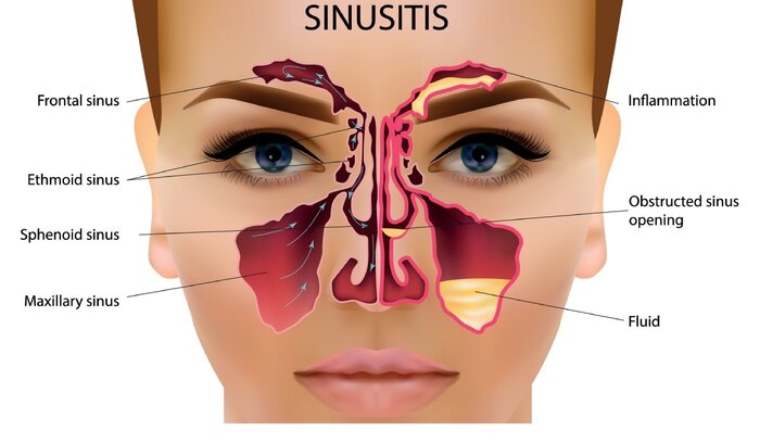 چطور سینوزیت را از سرماخوردگی تشخیص دهیم؟