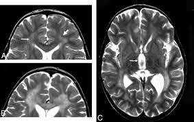 اولین مورد ژندرمانی برای درمان اختلال عصبی بدو تولد در انگلیس