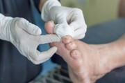 افزایش کلینیک‌های دولتی برای زخم پای دیابتی در اصفهان ضروریست