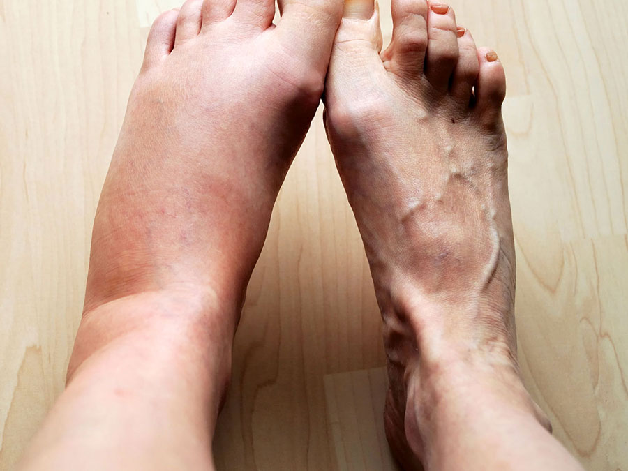 علائمی که نشان می‌دهد پاهایتان گردش خون خوبی ندارد