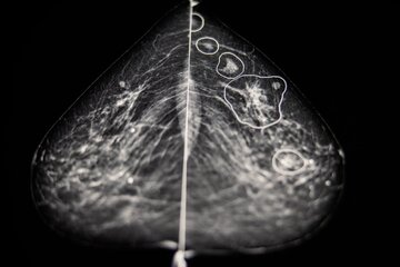 هوش مصنوعی به تشخیص سرطان سینه کمک می‌کند