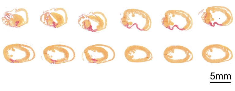 نوآوری پزشکی برای درمان بافت قلب پیش از وقوع حمله قلبی