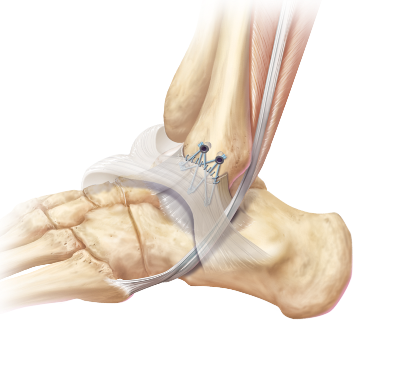 محققان ایرانی موفق به تولید نخ بخیه با کاربرد در جراحی ارتوپدی شدند