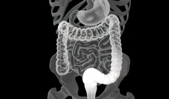 تحقیقات جدید علائم اولیه سرطان روده را شناسایی کرد
