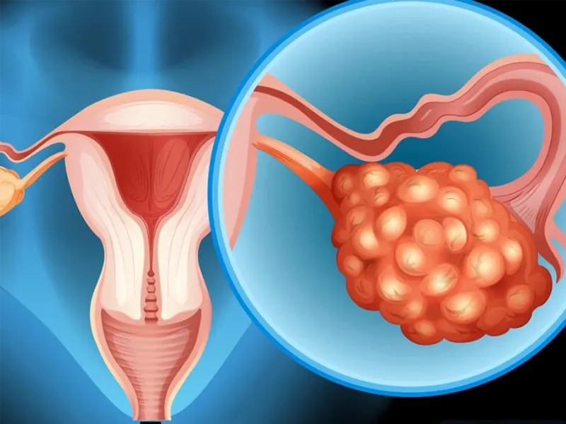 سرطان تخمدان؛ از علائم تا درمان