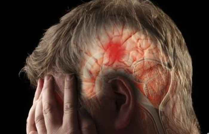 آیا پیش از سکته مغزی علائم هشداردهندهای وجود دارد؟