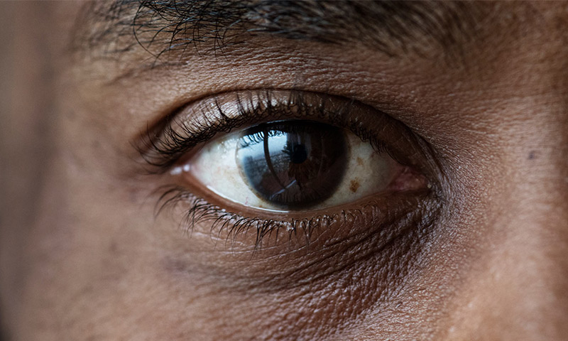 آشنایی با مگسپران و جرقه چشم