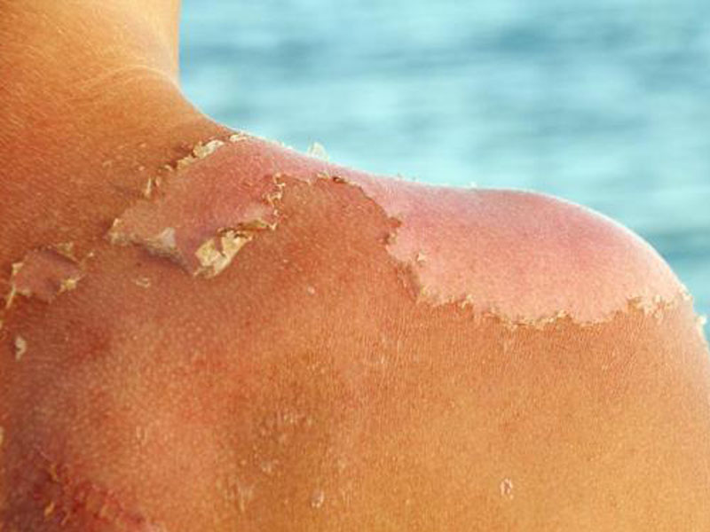 آفتابسوختگی چقدر میماند و چطور التیامش دهیم؟