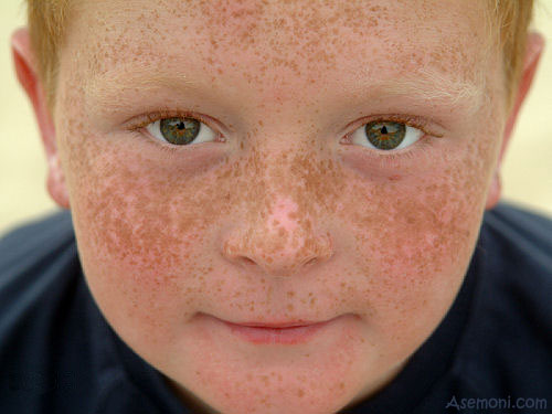 آفتابسوختگی چقدر میماند و چطور التیامش دهیم؟