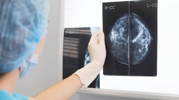 ترس از عود بیماری، عملکرد جنسی زنان با سابقه سرطان سینه را مختل می کند