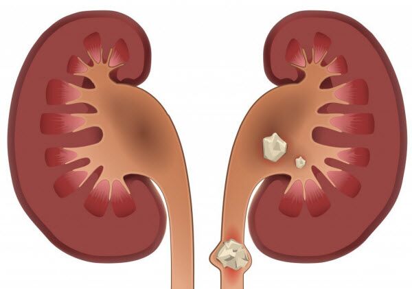 چه عواملی موجب تشکیل سنگ کلیه می‌شود؟