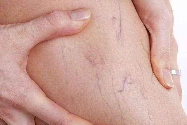 رگهای واریسی؛ عارضه جانبی شایع چاقی 1 رگهای واریسی؛ عارضه جانبی شایع چاقی