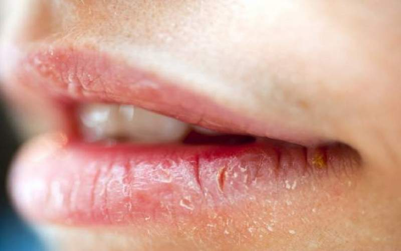 با ترک لب چه کنیم؟