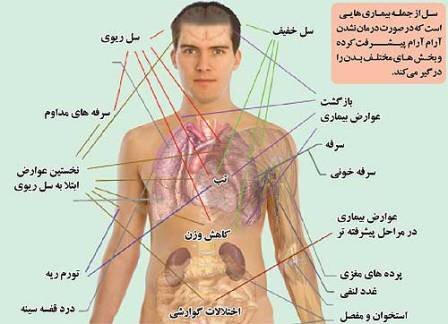 مازندران و بیماری سل