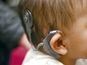 موفقیت ۱۰۰درصدی جراحی کاشت حلزون شنوایی در شمال کشور +فیلم