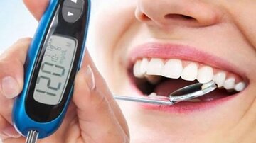 دیابت؛ زمینه‌ساز پوسیدگی دندان‌ها/ ۱۰ اقدام موثر در پیشگیری کدام است؟