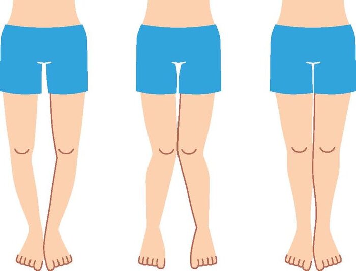 درباره پا پرانتزی در کودکان و بزرگسالان بیشتر بدانید