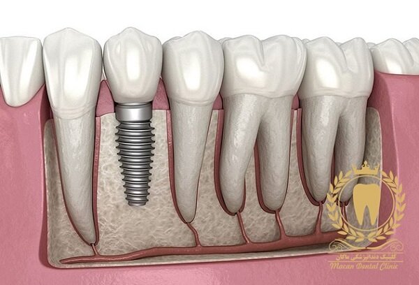 ایمپلنت دندان چگونه انجام می‌ شود؟