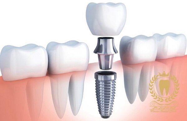 ایمپلنت دندان چگونه انجام می‌ شود؟