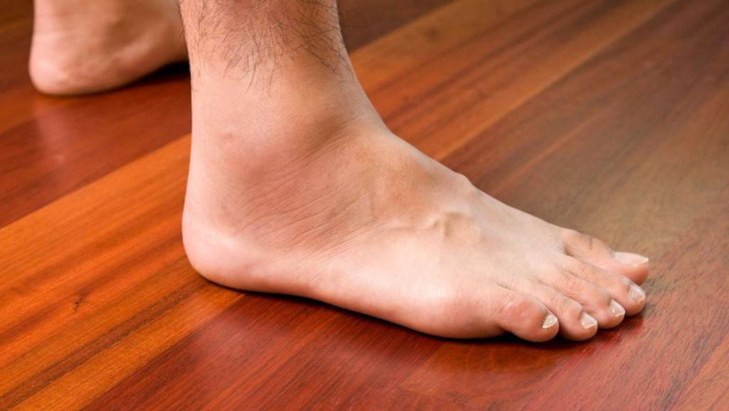درمان تورم کف و قوزک پا