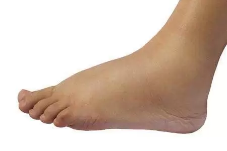 درمان تورم کف و قوزک پا