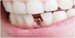 آیا ایمپلنت دندان موجب سرطان می شود؟