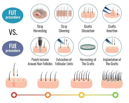 هزینه، مزایا و مراحل کاشت مو به روش SUPER FUE