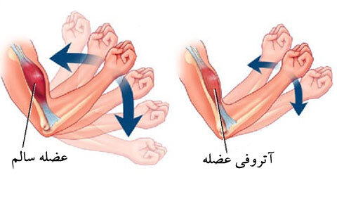 جراحی سینا و حاشیههایش؛ تامین داروی SMA چگونه انجام شد؟