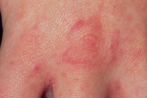 هر آنچه باید در مورد گال بدانید