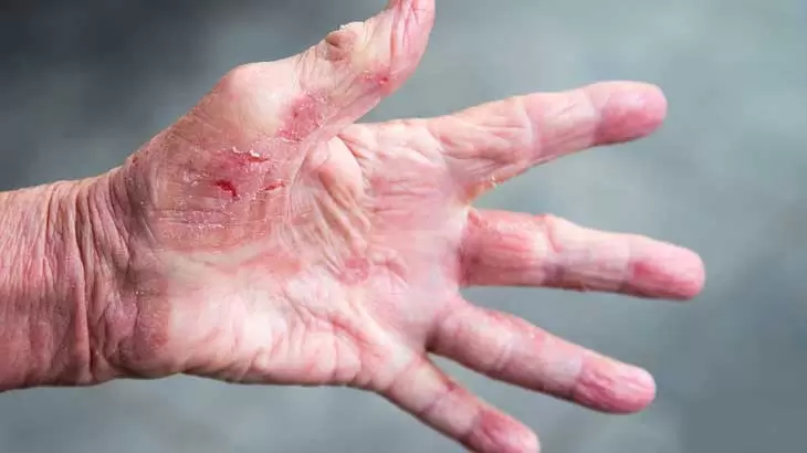 هر آنچه باید در مورد گال بدانید