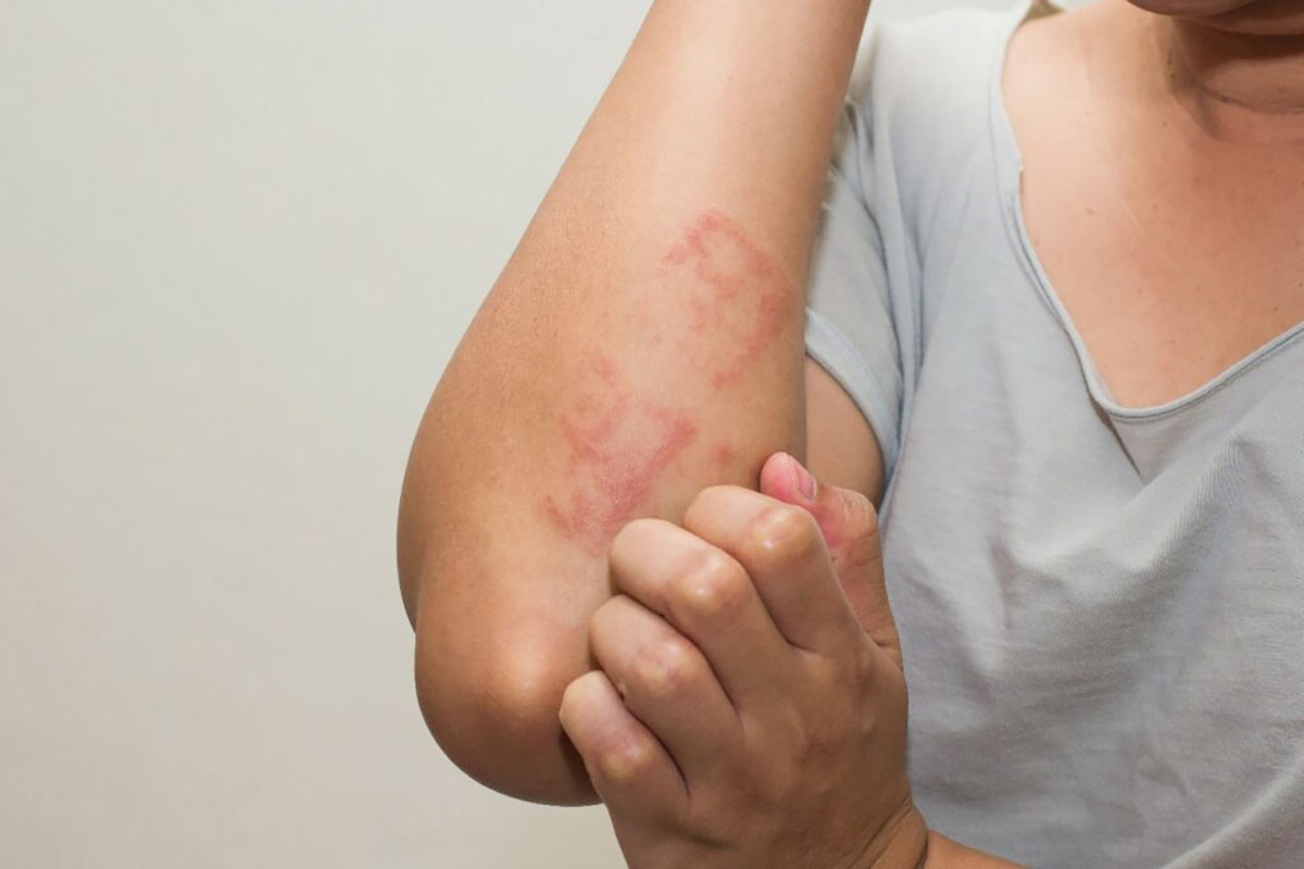 هر آنچه باید در مورد گال بدانید