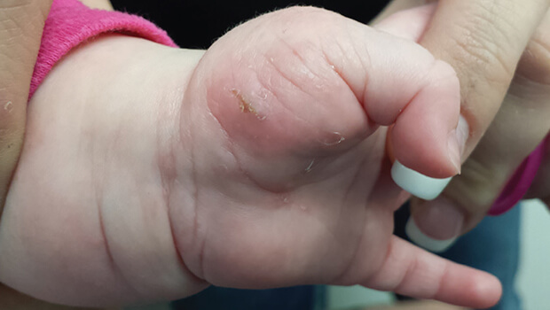 هر آنچه باید در مورد گال بدانید