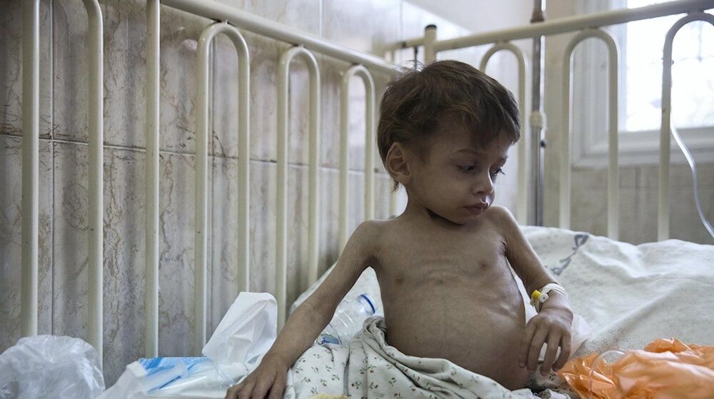 غذائی قلت نے مزید 7 فلسطینی بچوں کی جان لے لی