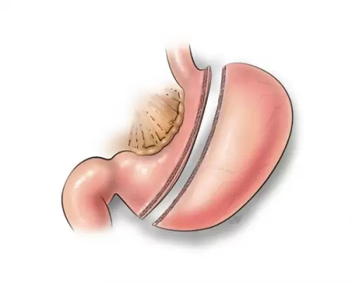 کدام جراحی لاغری برای شما مناسبتر است؟