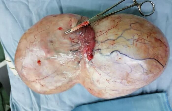 توده ۲ کیلو و ۶۰۰ گرمی از بدن یک بیمار سبزواری خارج شد